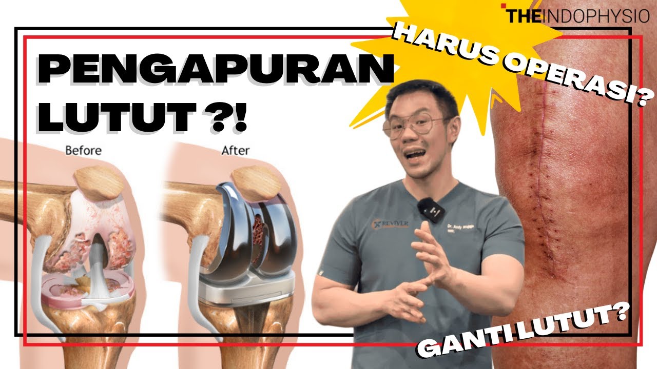 Apakah Pengapuran Harus Operasi / Ganti Lutut?