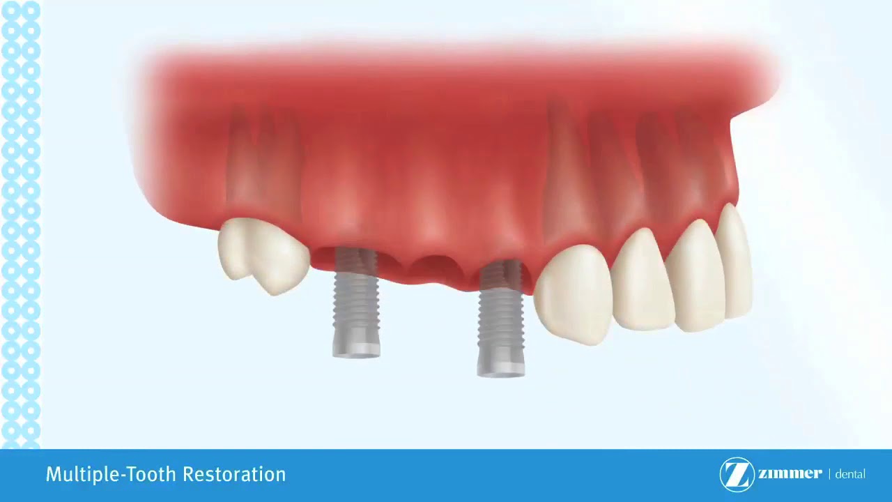 Multiple Tooth Restoration