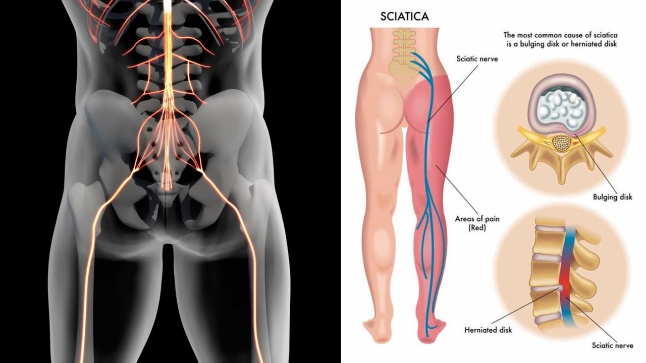 Leg Pain, Sciatica, and Disc Bulges – What’s Really Going On?