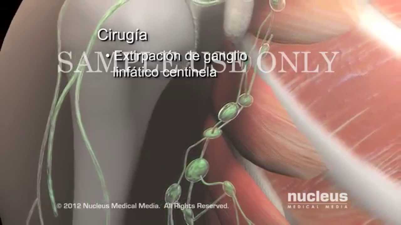 Tratamientos para el cáncer de mama