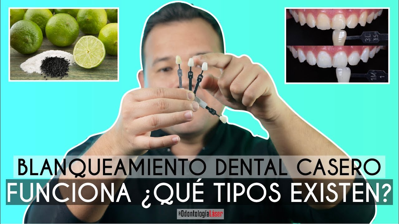 Blanqueamiento Dental Casero 🦷 &iquest;Funciona? &iquest;Qu&eacute; tipos de Blanqueamientos Existen? - Odontolog&iacute;a L&aacute;ser