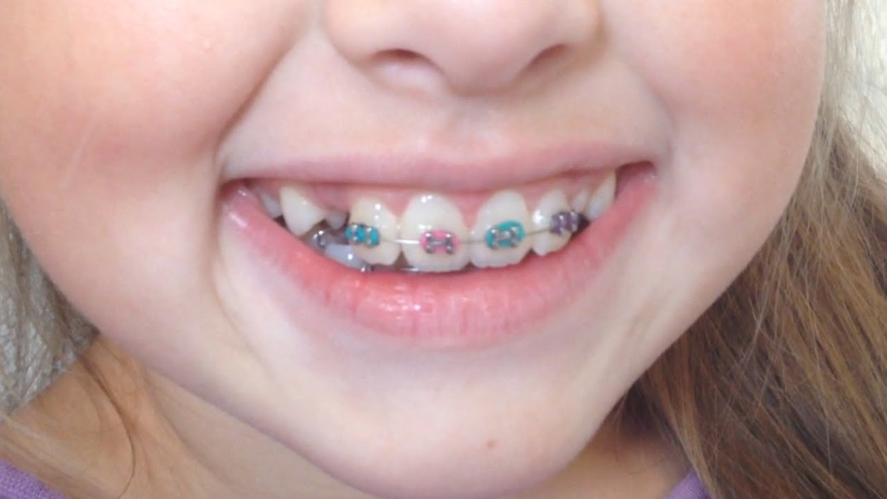 GABRIELLE GETS BRACES | EPISODE 8