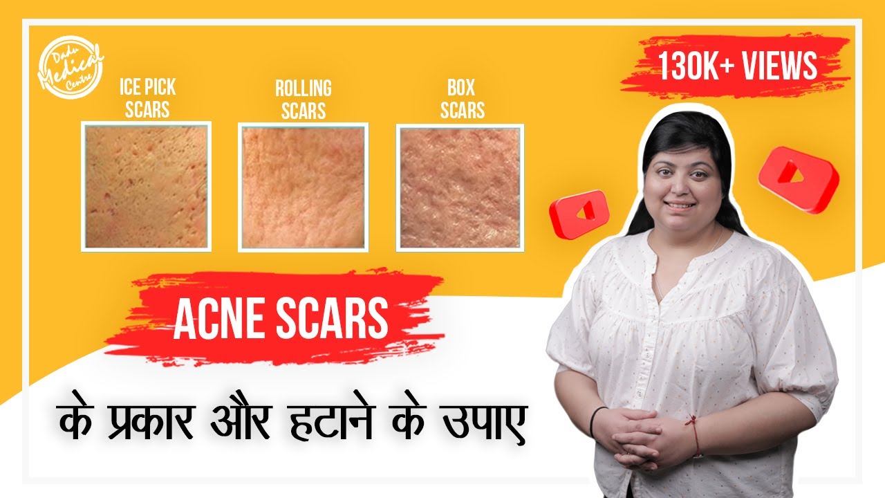 The Most Effective Acne Scars Treatment | Acne Scar Removal | Types of Acne Scars | Dr Nivedita Dadu