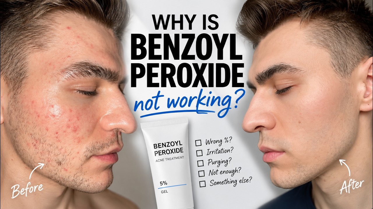Why is Benzoyl Peroxide not working? Short contact therapy | How I cleared up my acne.