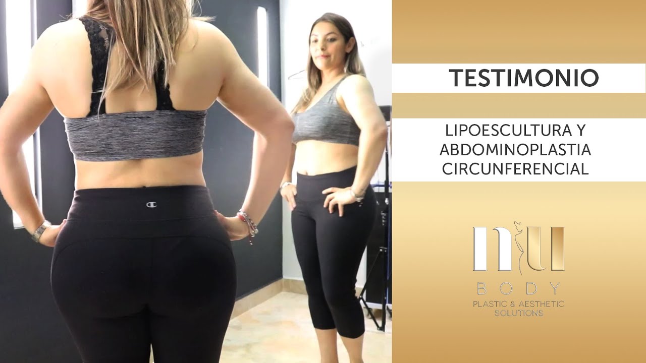 TESTIMONIO LIPOESCULTURA Y ABDOMINOPLASTIA CIRCUNFERENCIAL | Dr. Mecott | Nubody | #cirugíaplástica
