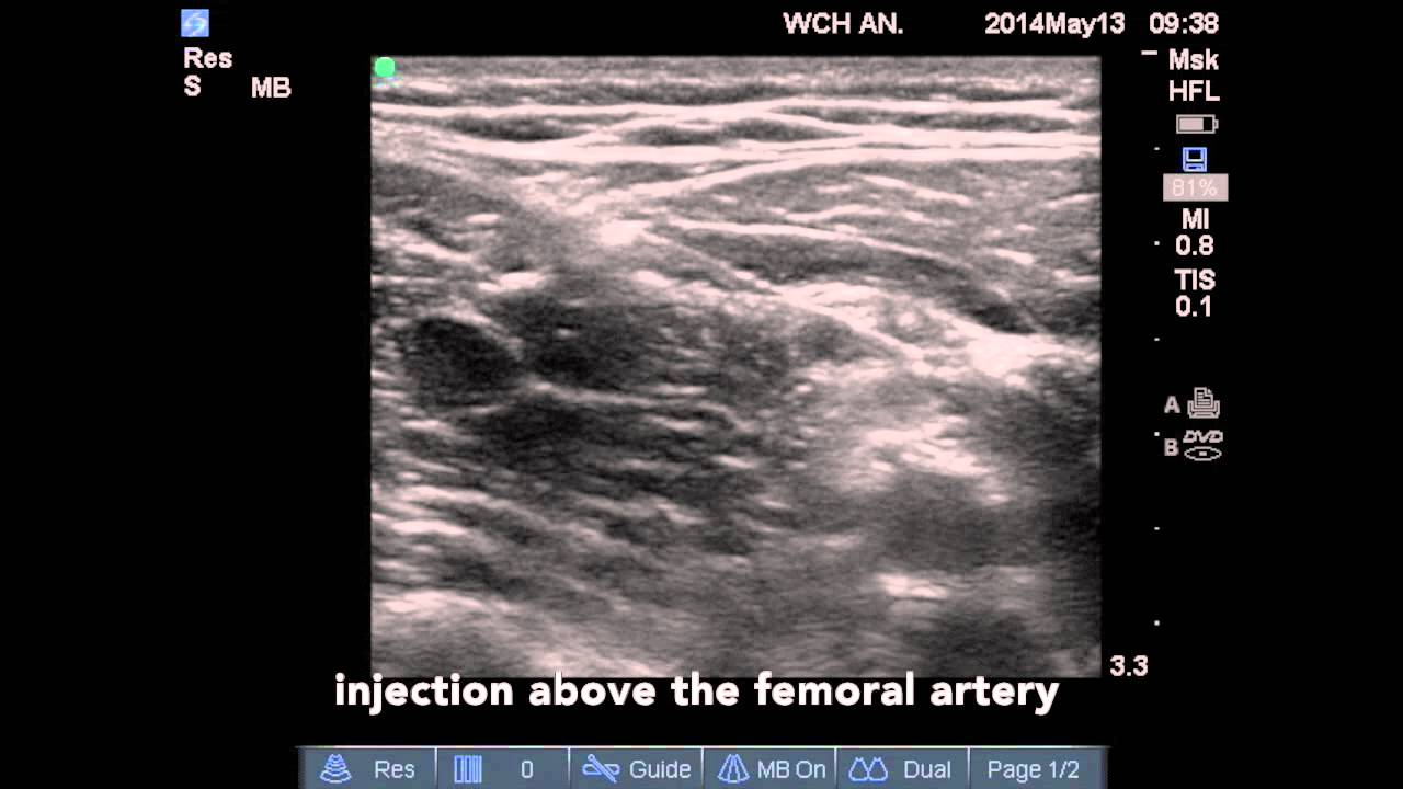 Adductor Canal Block (In Plane Approach)