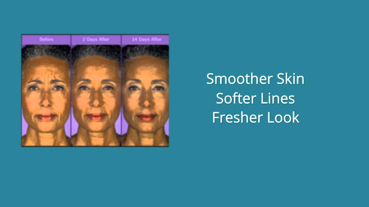 Botox West Palm Beach | Palm Beach County FL (561) 641-9490