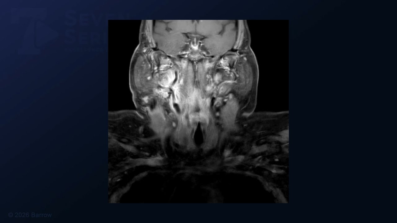 Transcervical Approach for Resection of a Glomus Vagale Tumor