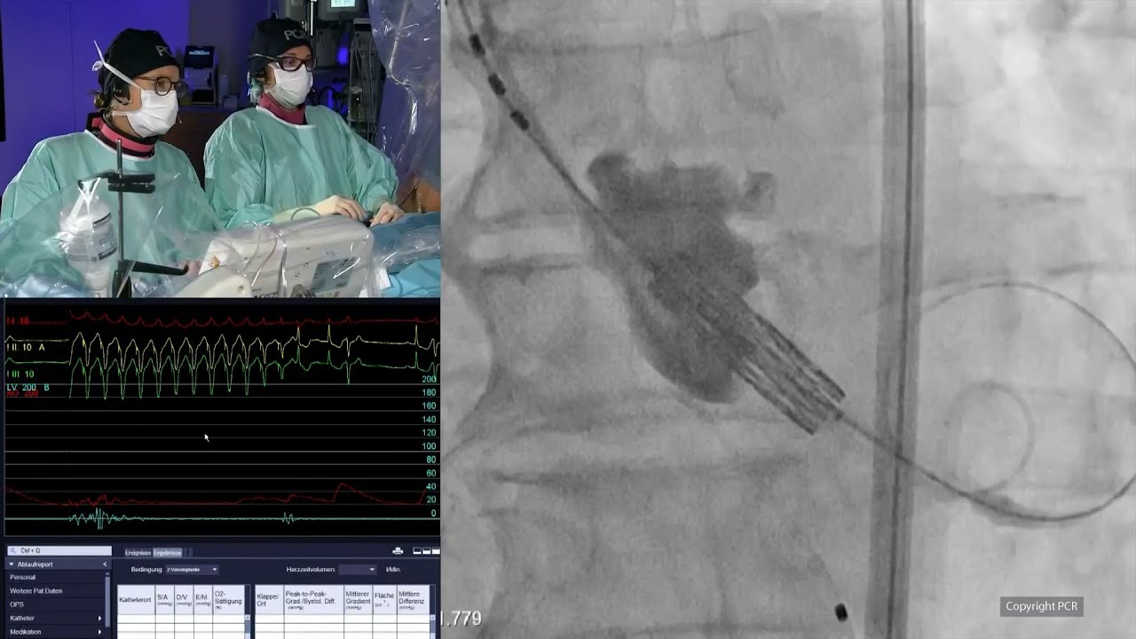 TAVI in 2025: transforming care with the new valvular heart disease guidelines - PCR London Valves