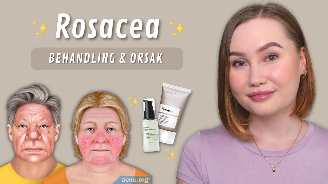 Allt du behöver veta om Rosacea