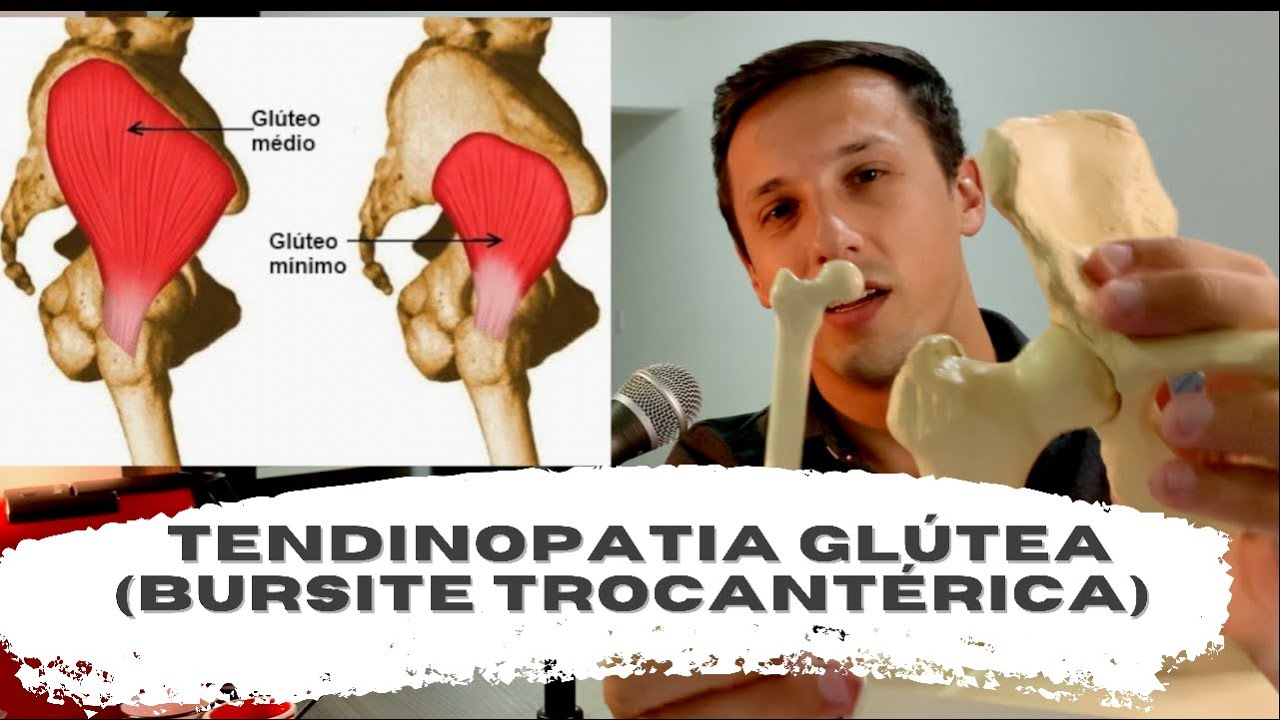 Tendinopatia Glútea (BURSITE TROCANTÉRICA) do Quadril