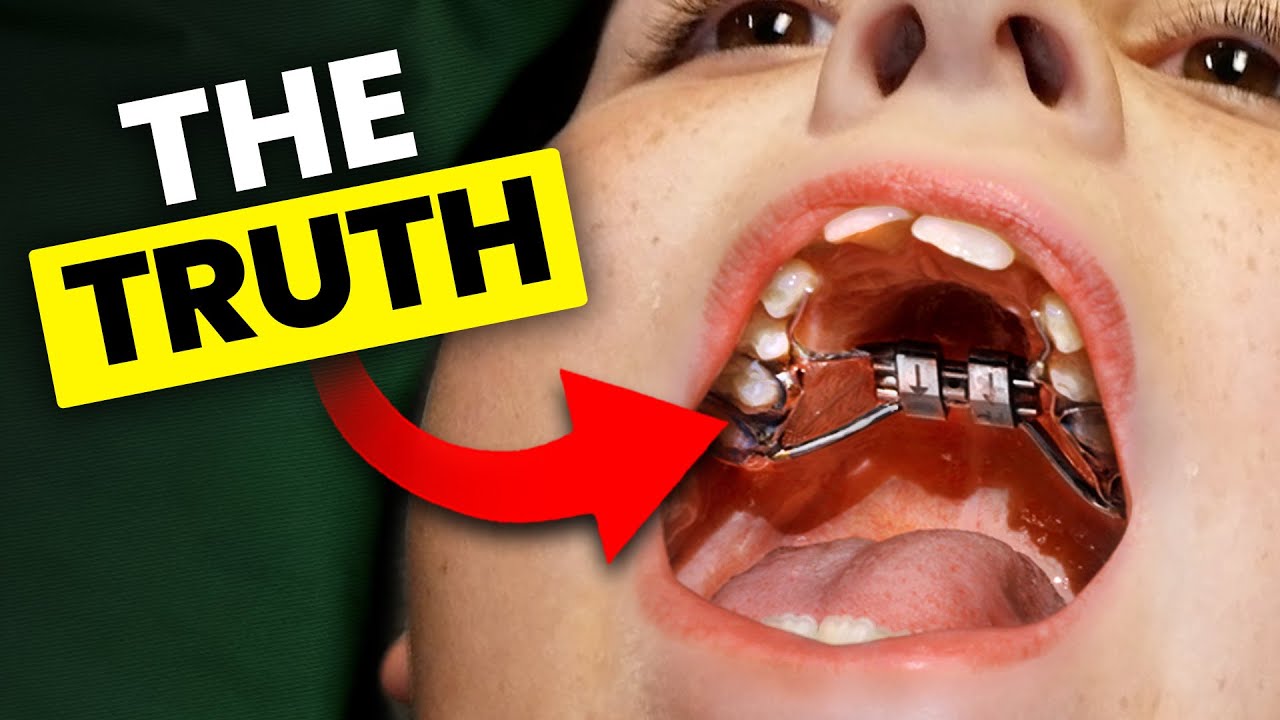 Why you need an EXPANDER?…How expanders work | McKinney Orthodontist