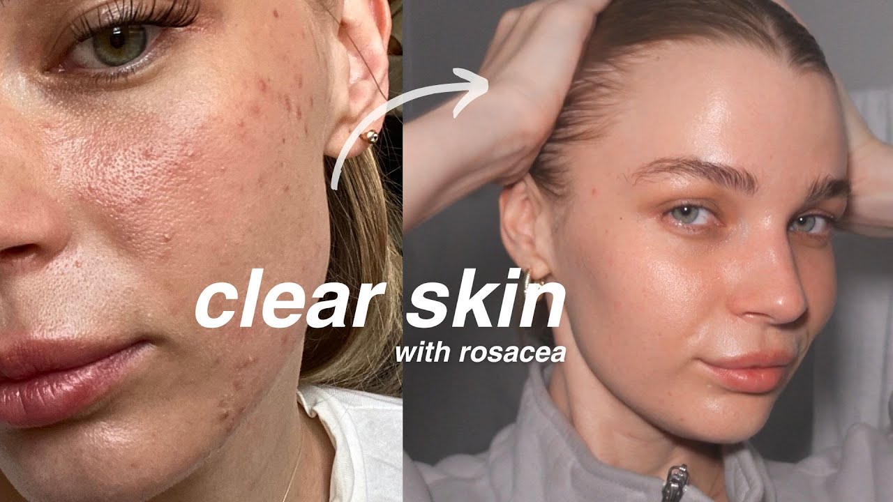 my affordable rosacea night skincare for glowy skin