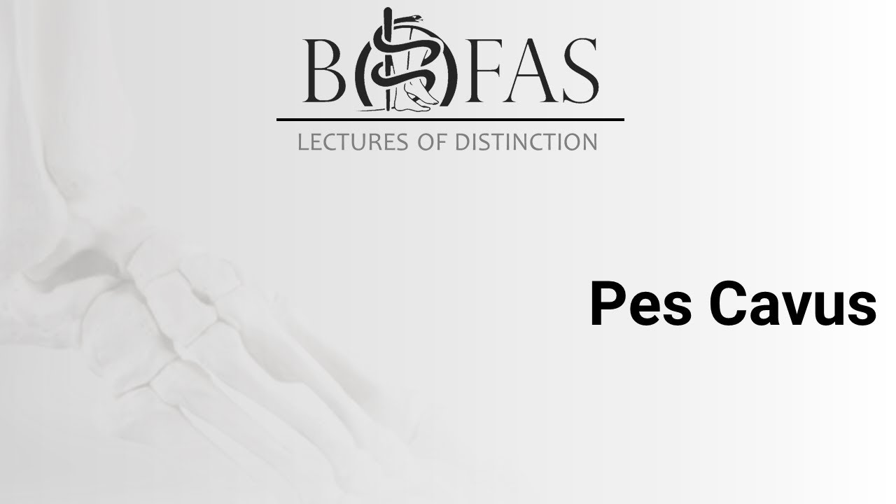 Pes Cavus - Лекции BOFAS с отличием