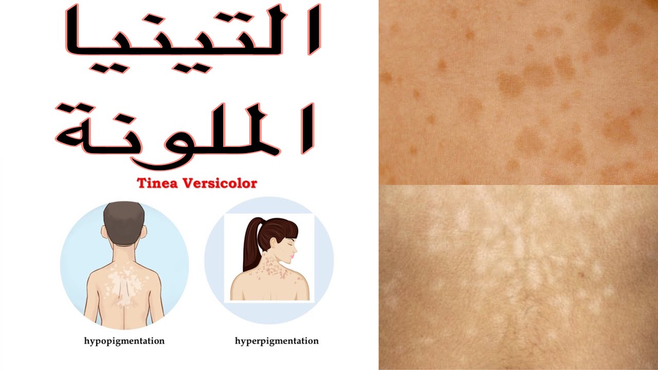 التينيا الملونة العلاج و الوقاية مع د. نجلاء راشد