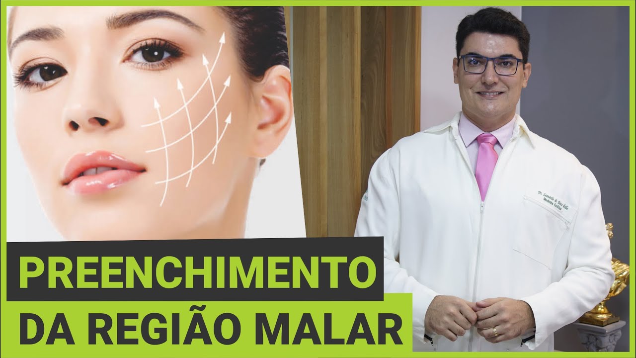 Harmonização Facial através do Preenchimento da Região Malar com Ácido Hialurônico #acidohialuronico