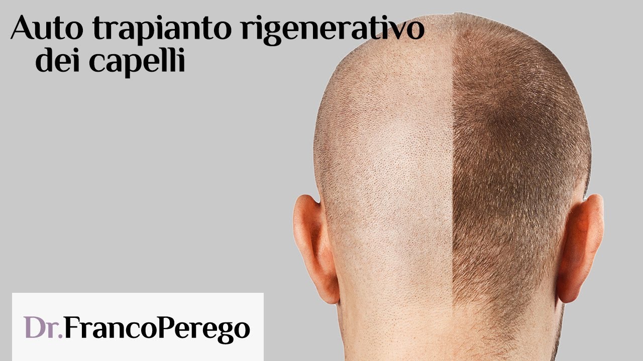 Autotrapianto rigenerativo dei capelli