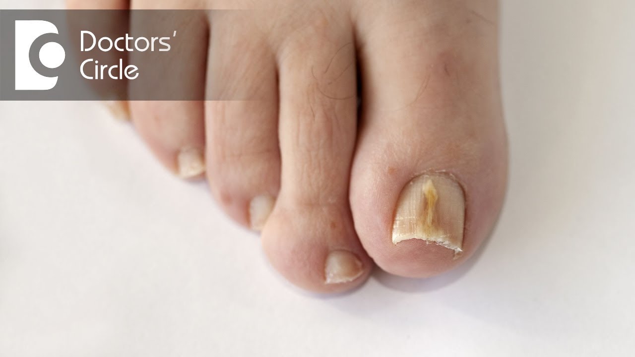 What are causes of vertical dark line on big toe? - Dr. Rajdeep Mysore