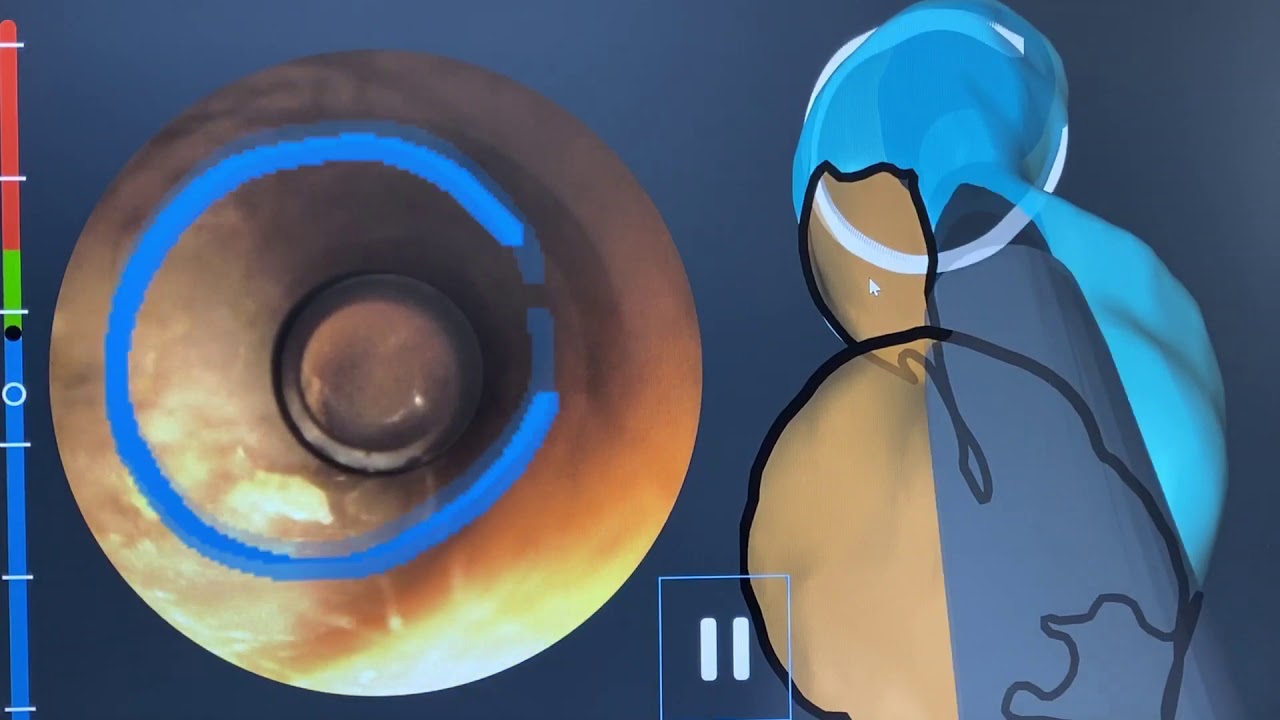 Introducing Otoscan - A New Way of Taking Ear Impression (by Dr. Samai Chavez)