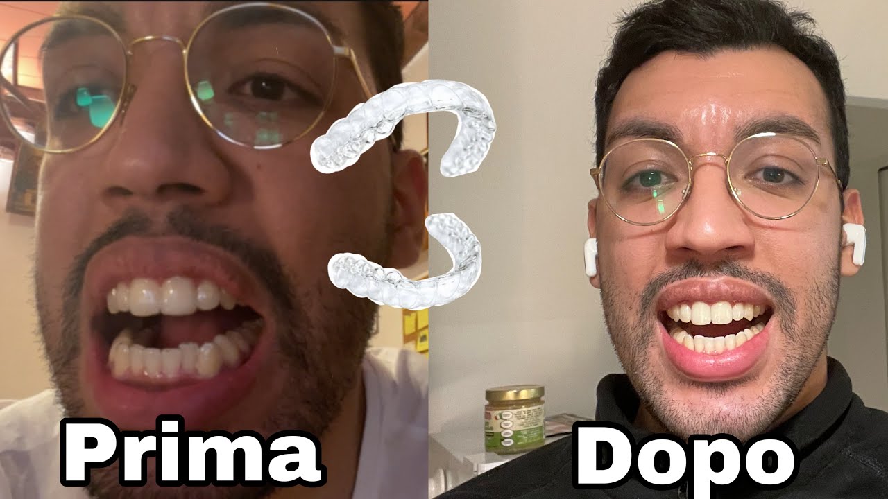 Provo gli Allineatori invisibili Dr Smile - Impress Parte 1