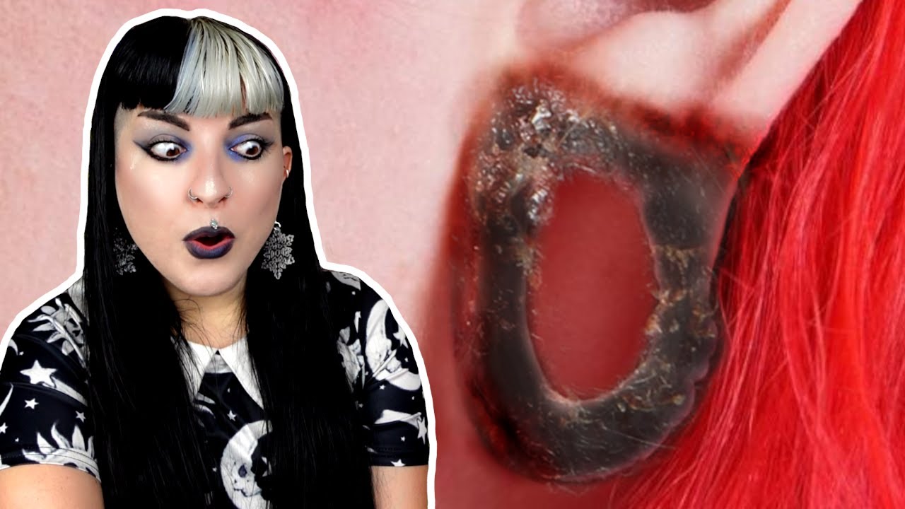 What Happens When Stretched Ear Lobe Reconstruction Goes Wrong?
