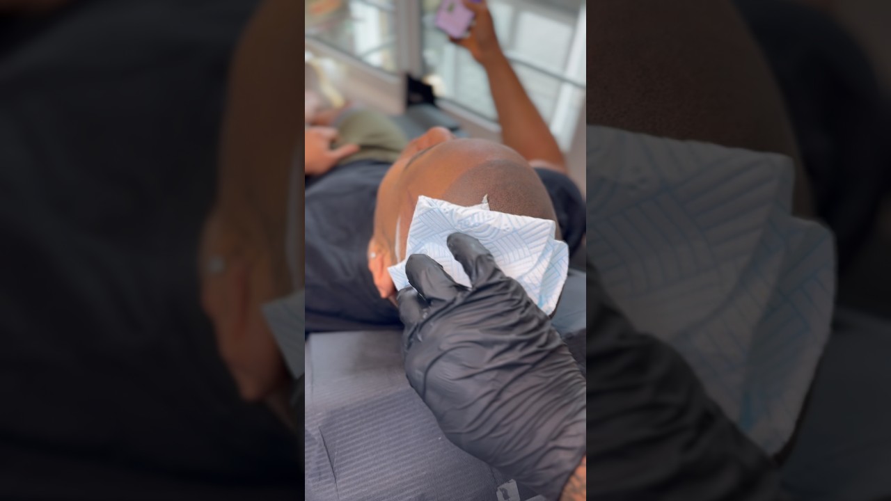 Final wipe. Fresh results. Another transformation locked in 🔐 • SMP (Scalp Micropigmentation)