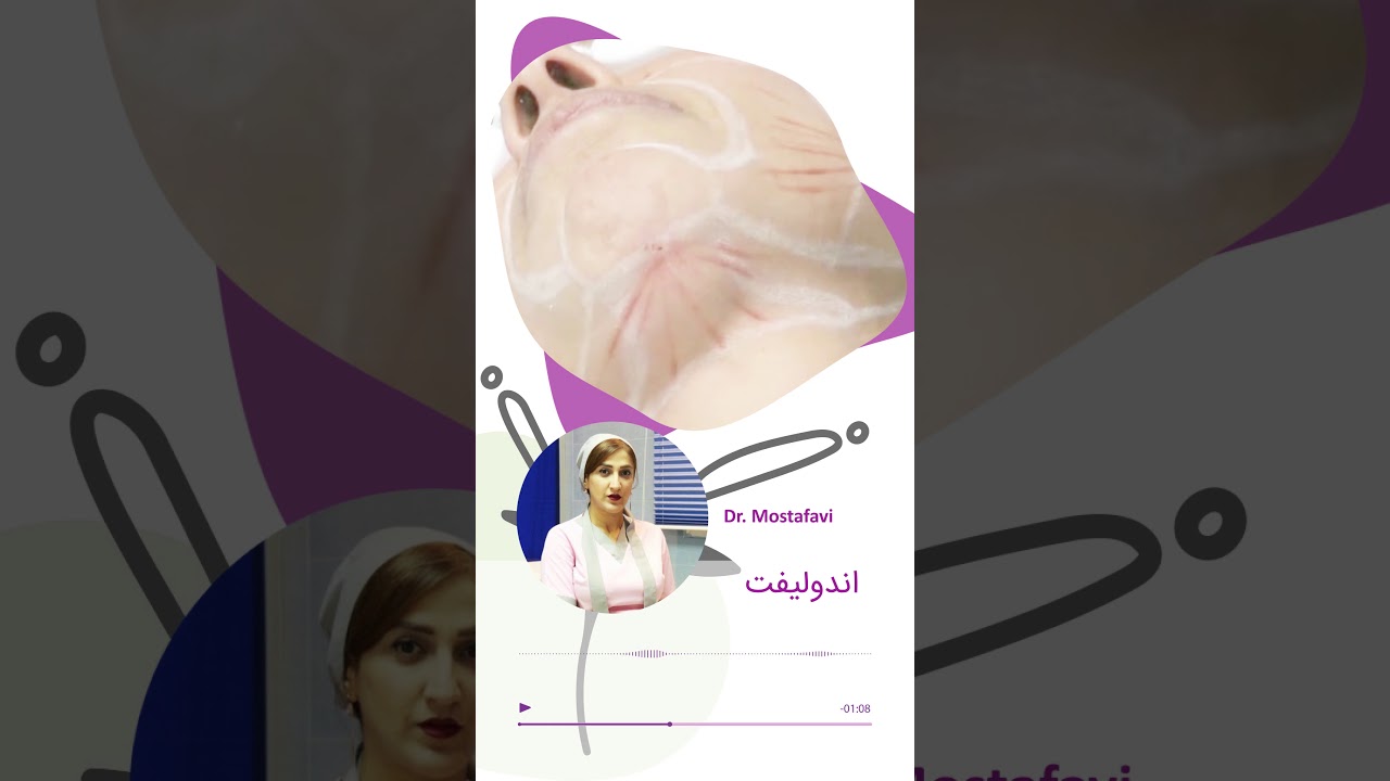 همه چیز درباره اندولیفت