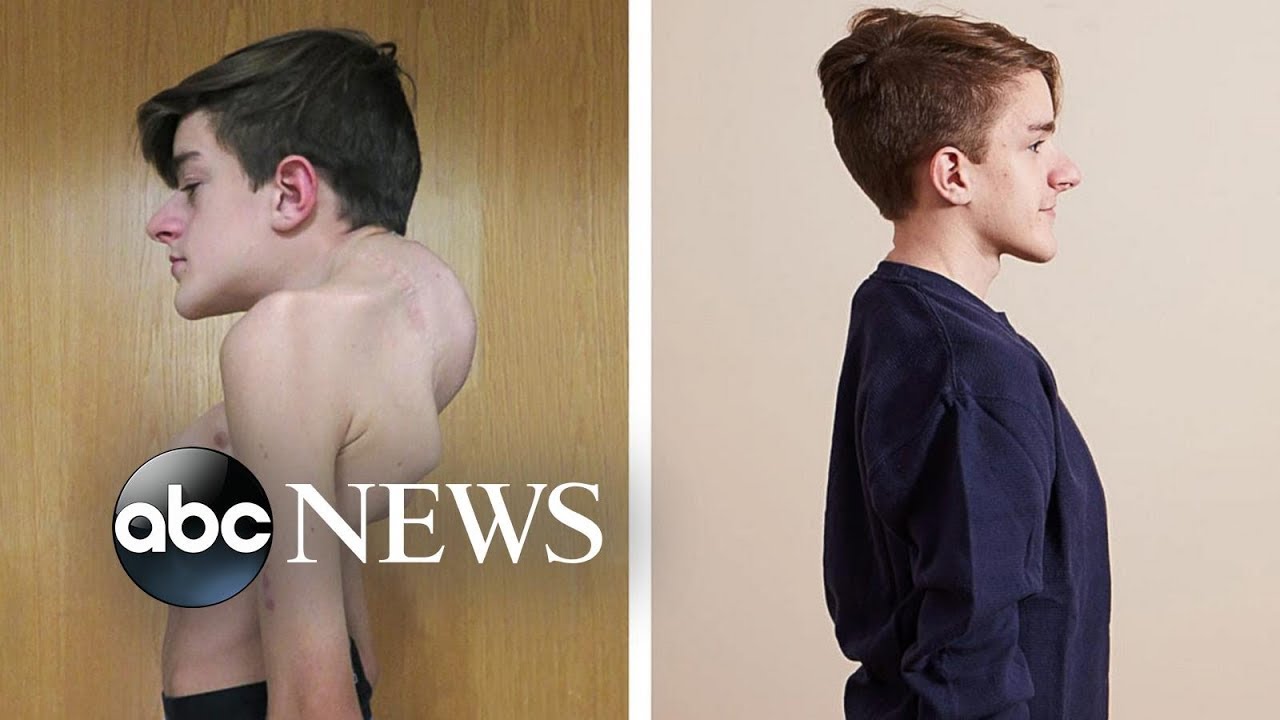 19-year-old has miraculous recovery after battling severe scoliosis