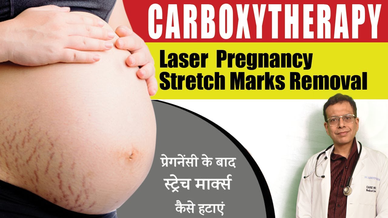 Carboxytherapy in Delhi | Laser Pregnancy Stretch Marks Removal in Delhi | Care Well Medical Centre