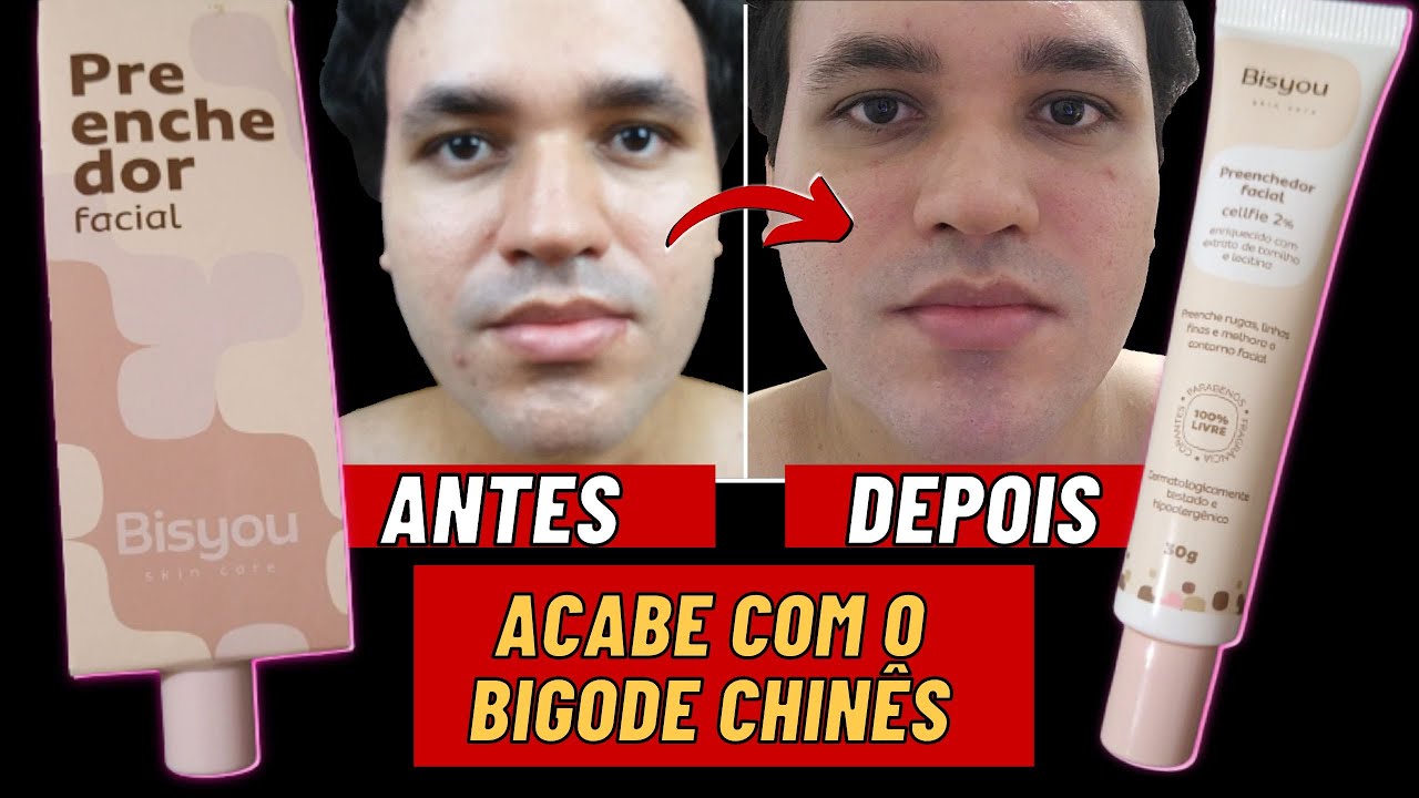 BISYOU PREENCHEDOR FACIAL COM ANTES E DEPOIS │ Como acabar com o Bigode Chinês e as rugas do rosto?