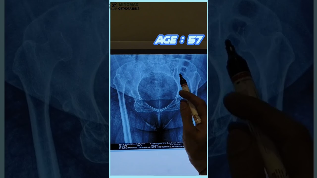 DDH Treatment in various age groups