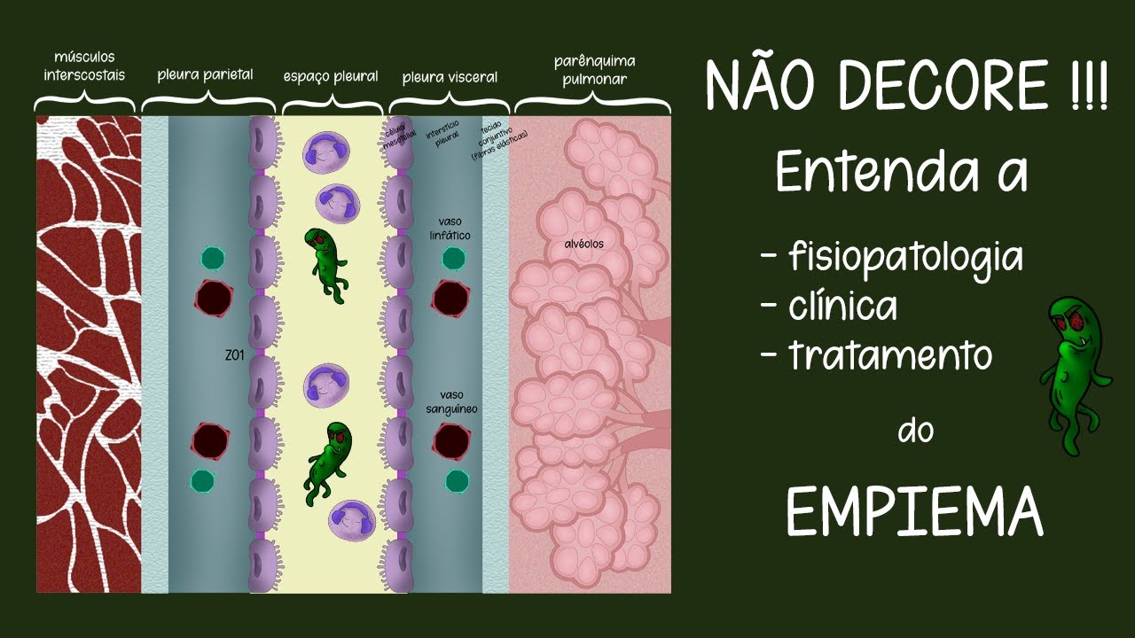 Derrame Pleural - Empiema (causas, clínica, laboratório, tratamento)