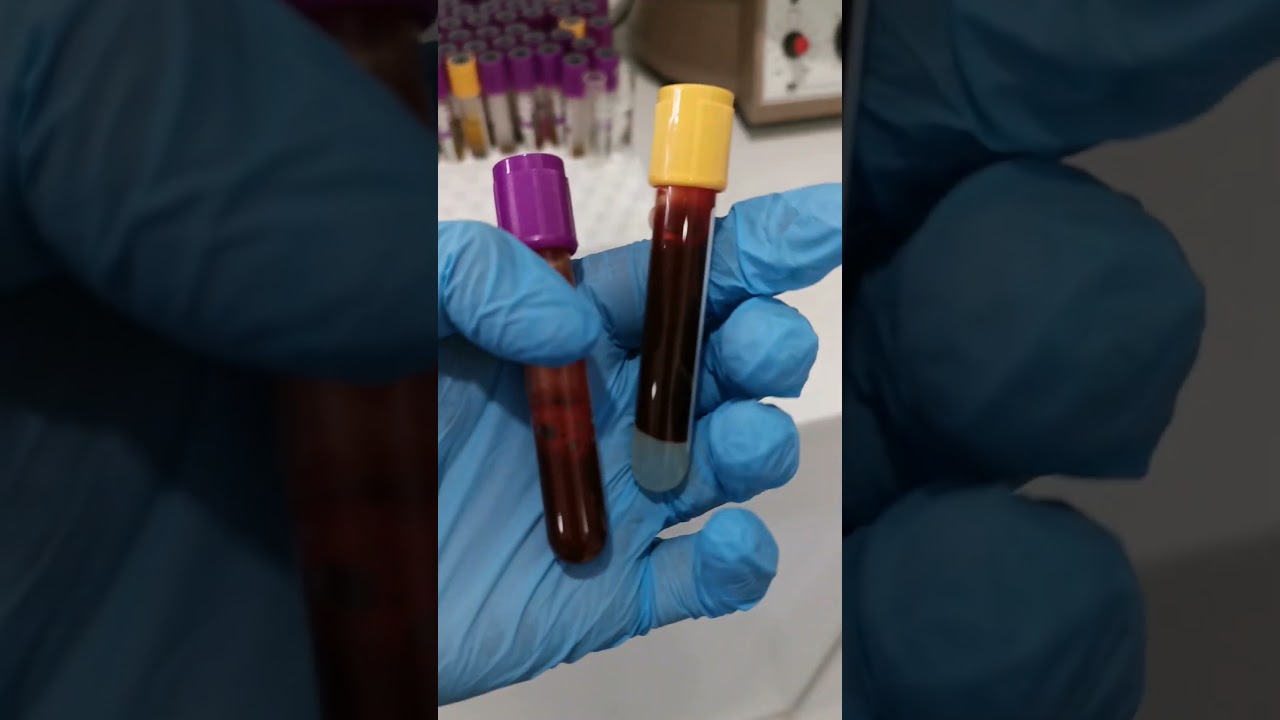 blood testing Laboratory life #lablife #laboratory #mls #cls #medtechstudent #medtech