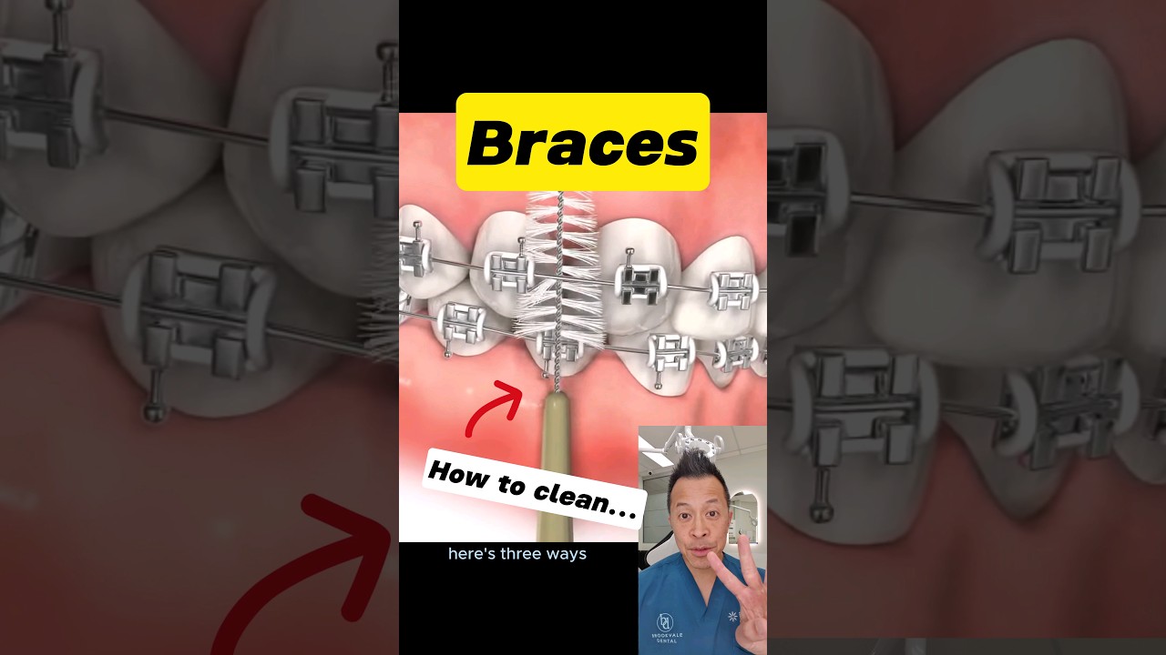 Top Hacks for Cleaning Your Braces at Home #dentallan #dentist #shorts