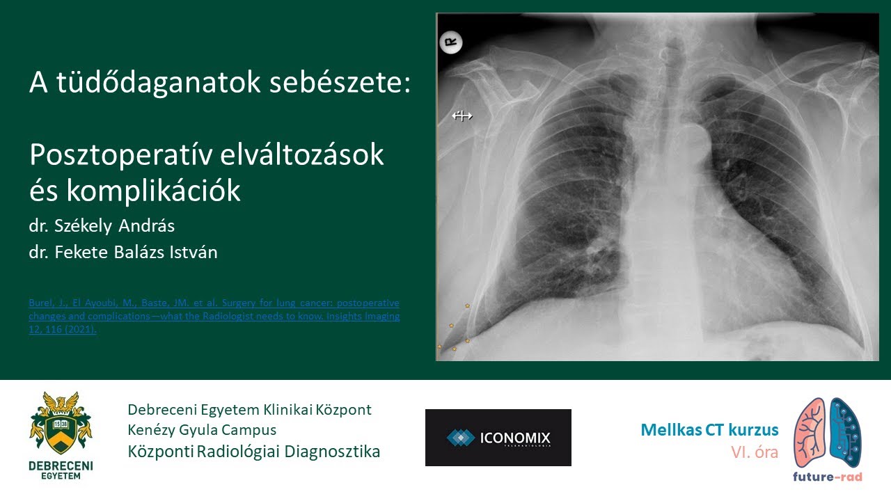 A tüdődaganatok sebészete: posztoperatív elváltozások és komplikációk.