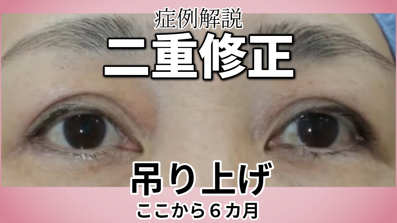 二重修正。目頭側の幅を狭く。吊り上げ。腱膜固定はなし。手術後６か月の症例解説