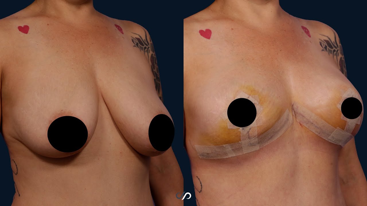 Breast Lift Before and After | Los Angeles | Dr. David Stoker