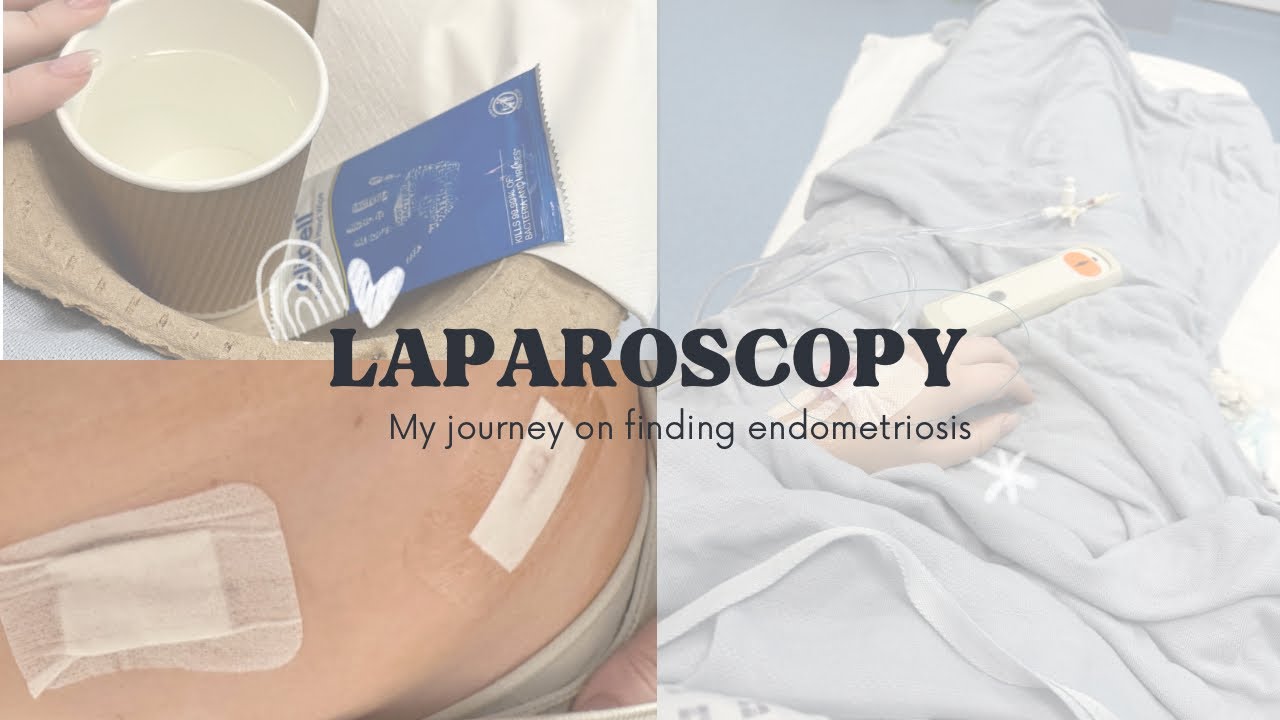 LAPAROSCOPY & FINDING ENDOMETRIOSIS - my story