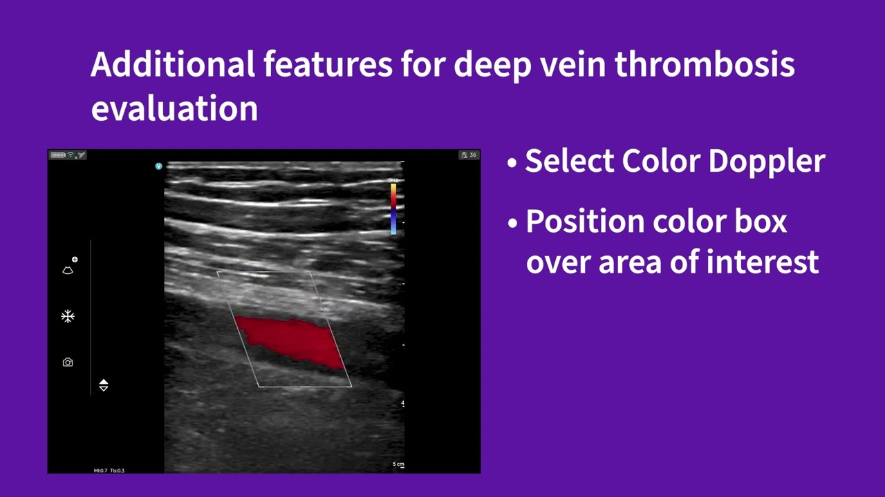Vscan Air™ | Using presets for evaluations: DVT
