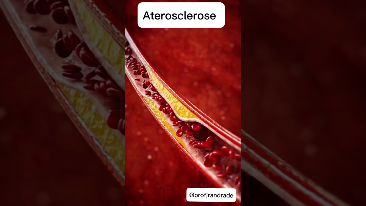 Forma&ccedil;&atilde;o de placa ateroscler&oacute;tica #ciencia #saude #aterosclerose