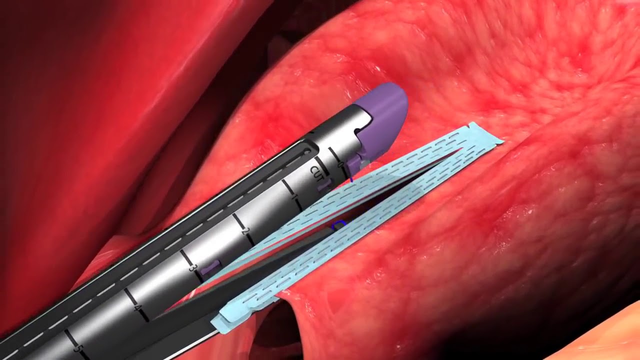 Animation   Endo GIA&trade; Reinforced Reload with Tri Staple&trade; Technology    Chapter 3 orSo6xtt1DI