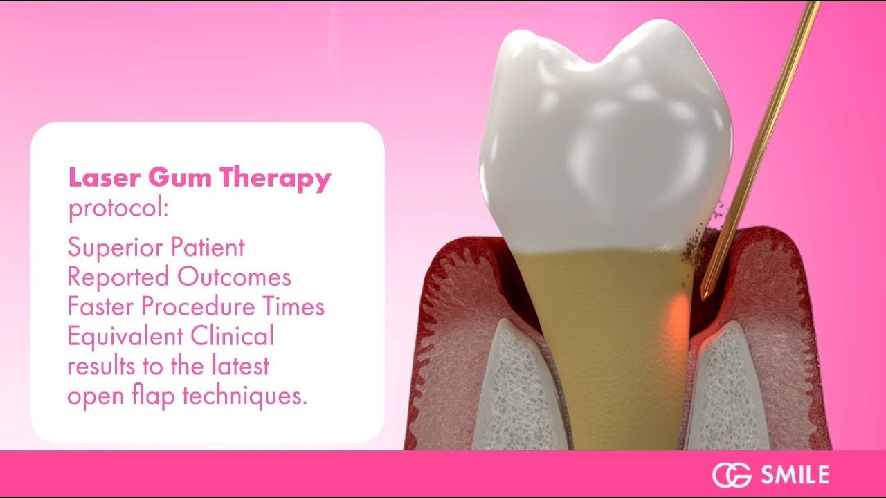 New Laser Gum Treatment for Healthier Gums | FDA-Cleared Technology at CG Smile
