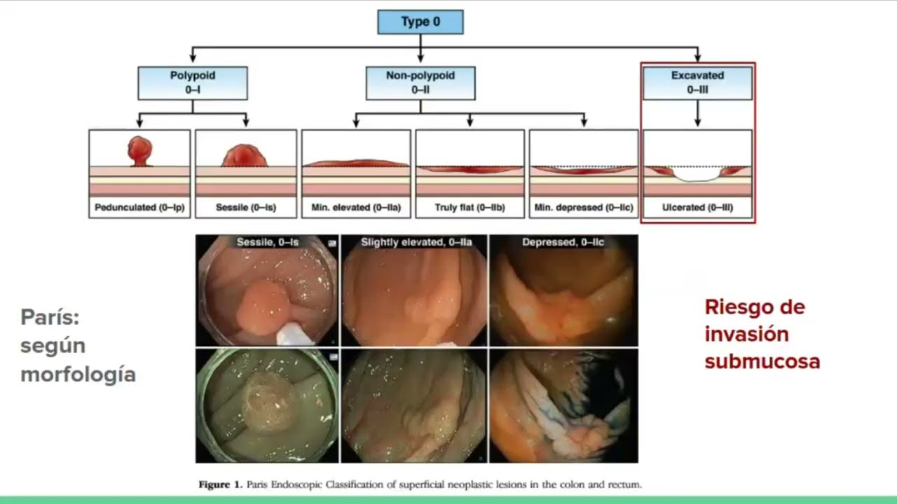 P&oacute;lipos del colon: Valoraci&oacute;n y manejo - Iv&aacute;n S&eacute;neca Echeverr&iacute;a G&oacute;mez