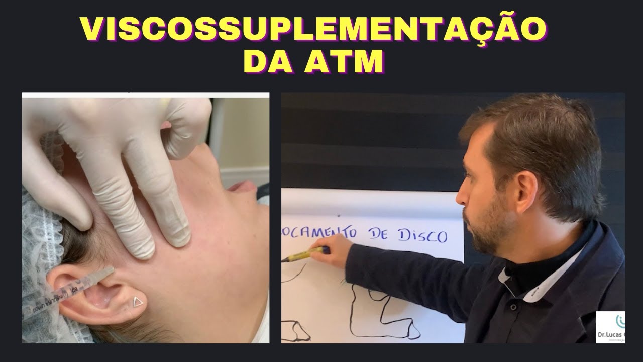 Viscossuplementação da ATM