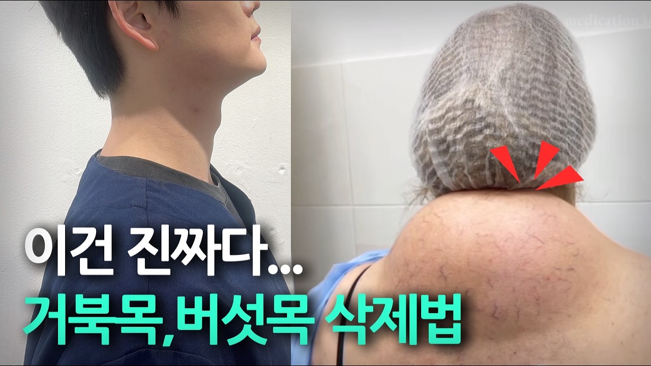 뒷목에 튀어나온 '이것', 단순한 살이 아닙니다 버섯목,거북목 방치하면 더 커지고 위험해요