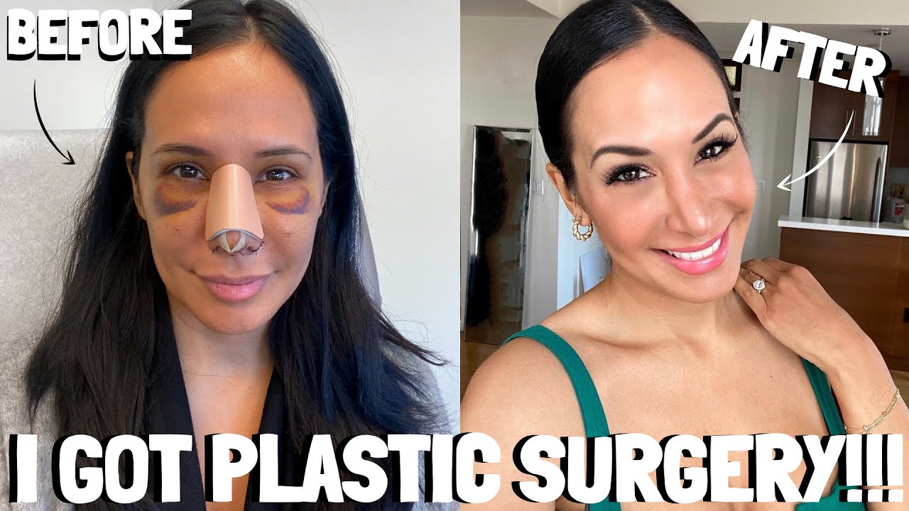 MY PLASTIC SURGERY JOURNEY!!! | JO DE LA ROSA