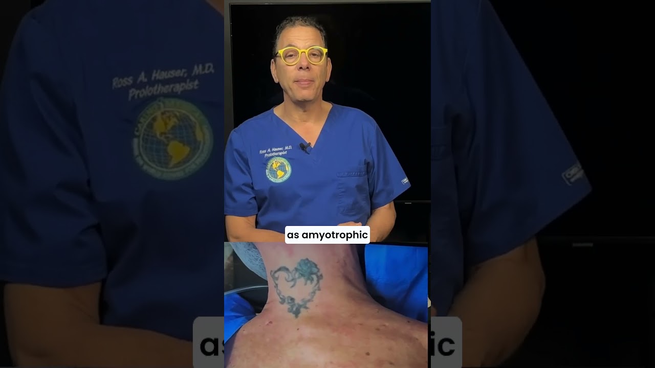 Spontaneous fasciculations #lougehrigsdisease #ALS #musclespasm, #pinchednerve #EMG