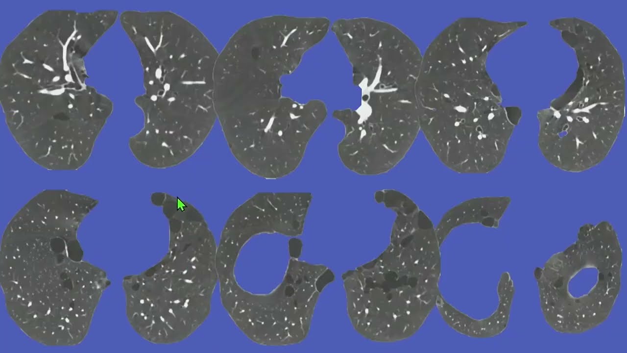 Cystic Lung Disease