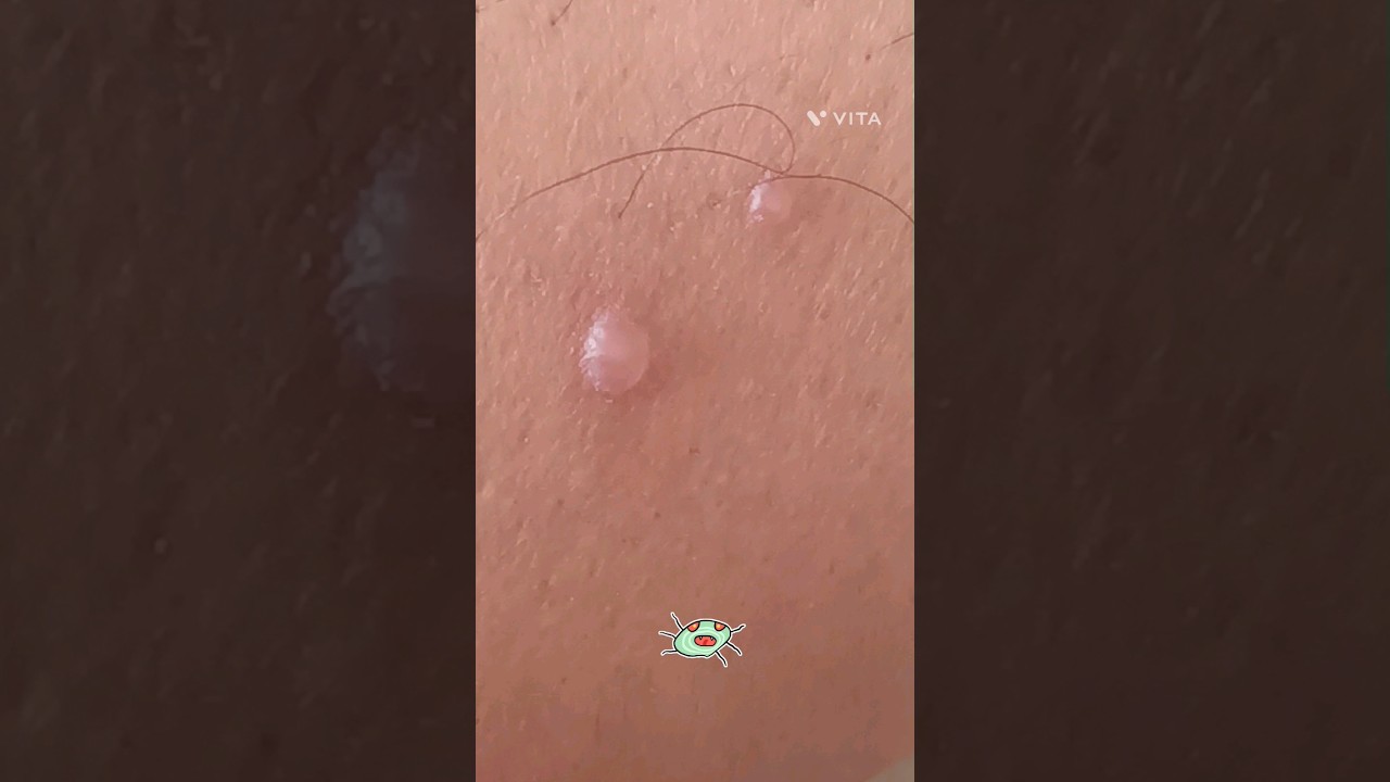 #varicella #zoster #chickenpox