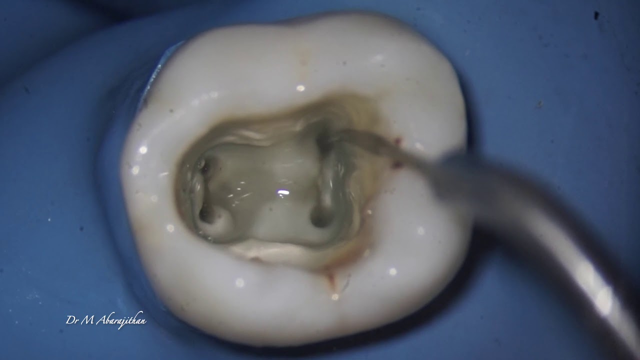 comparison of irrigant activation devices in endodontics